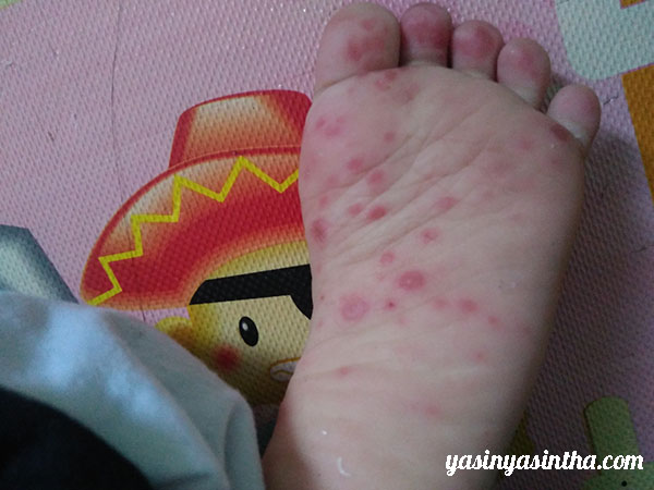 bintik merah flu singapur pada telapak kaki anak