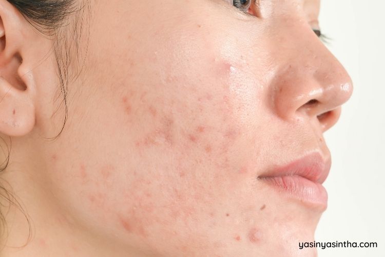 masker untuk kulit berjerawat